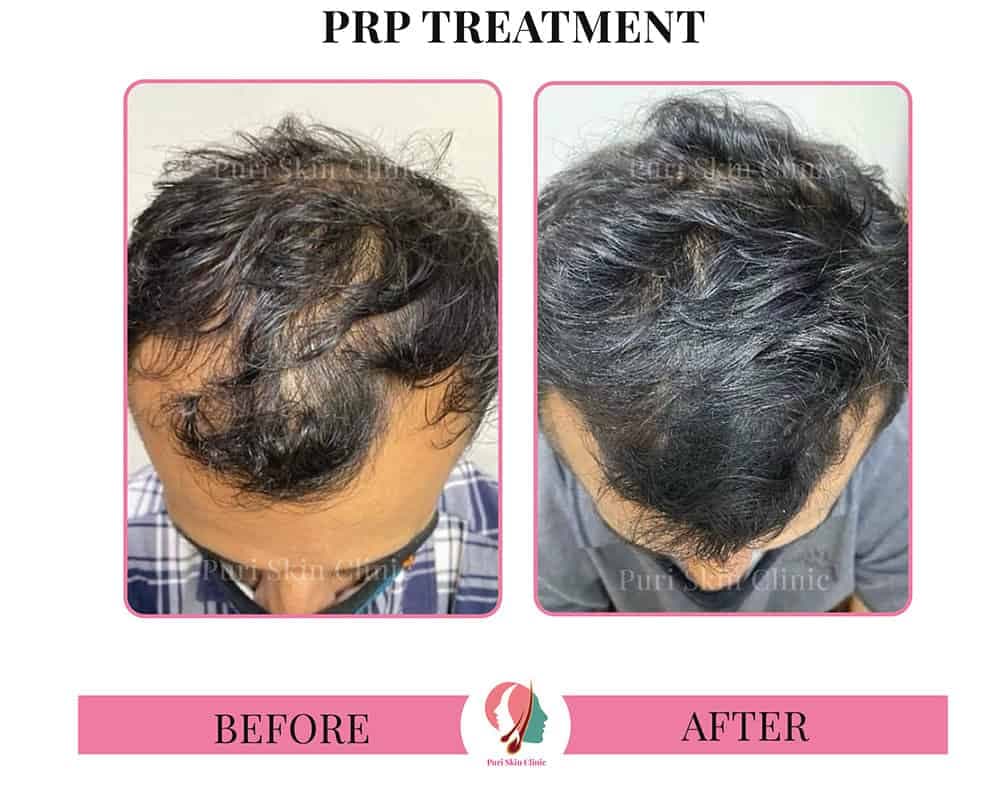 PRP Treatment 3