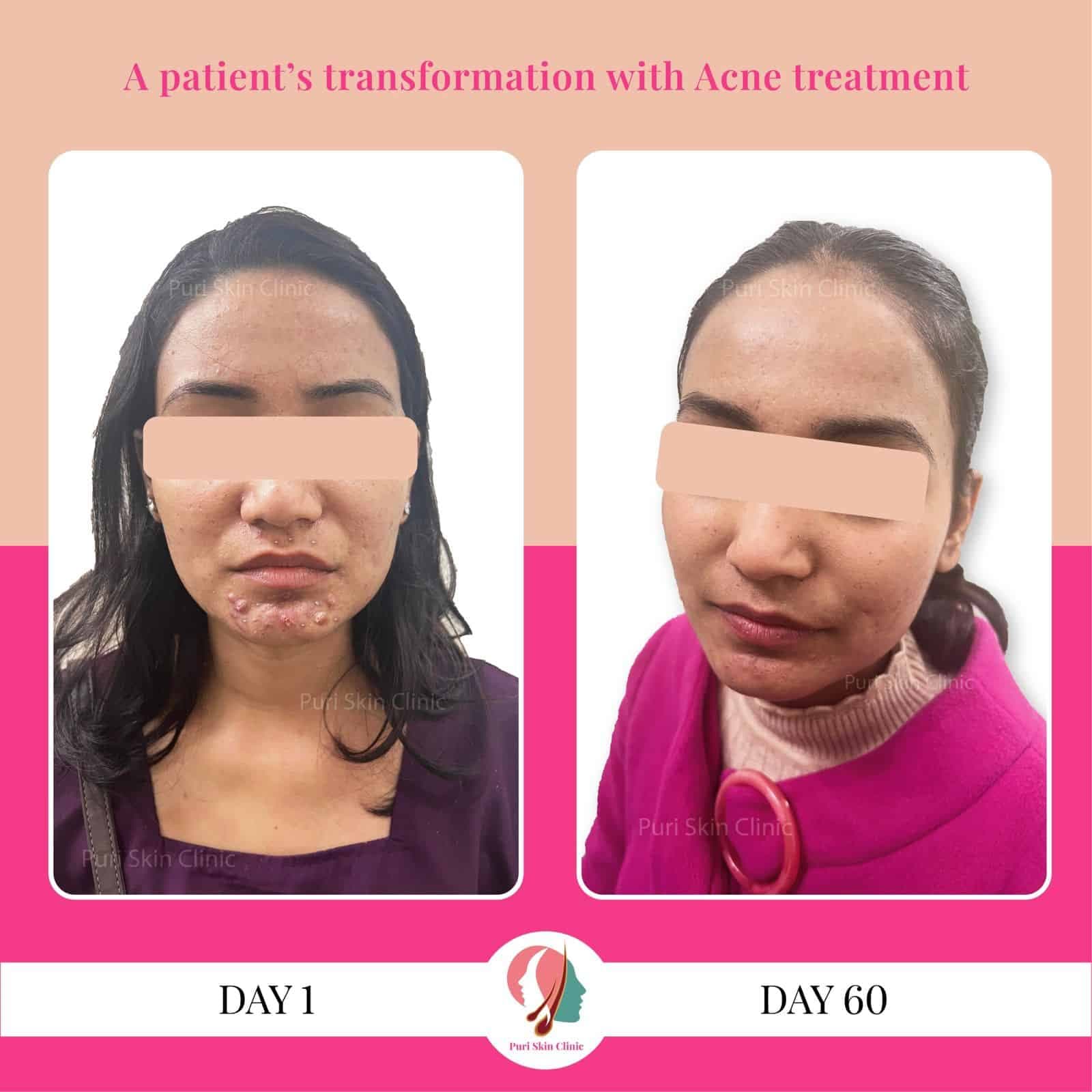 क्या बच्चों की स्किन पर बार-बार होने वाली खुजली और लालिमा एक्जिमा का संकेत होता है? डॉक्टर से इसके लक्षणों के बारे में!