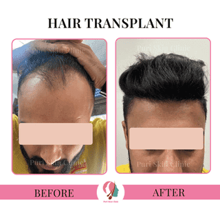 Hair Transplant